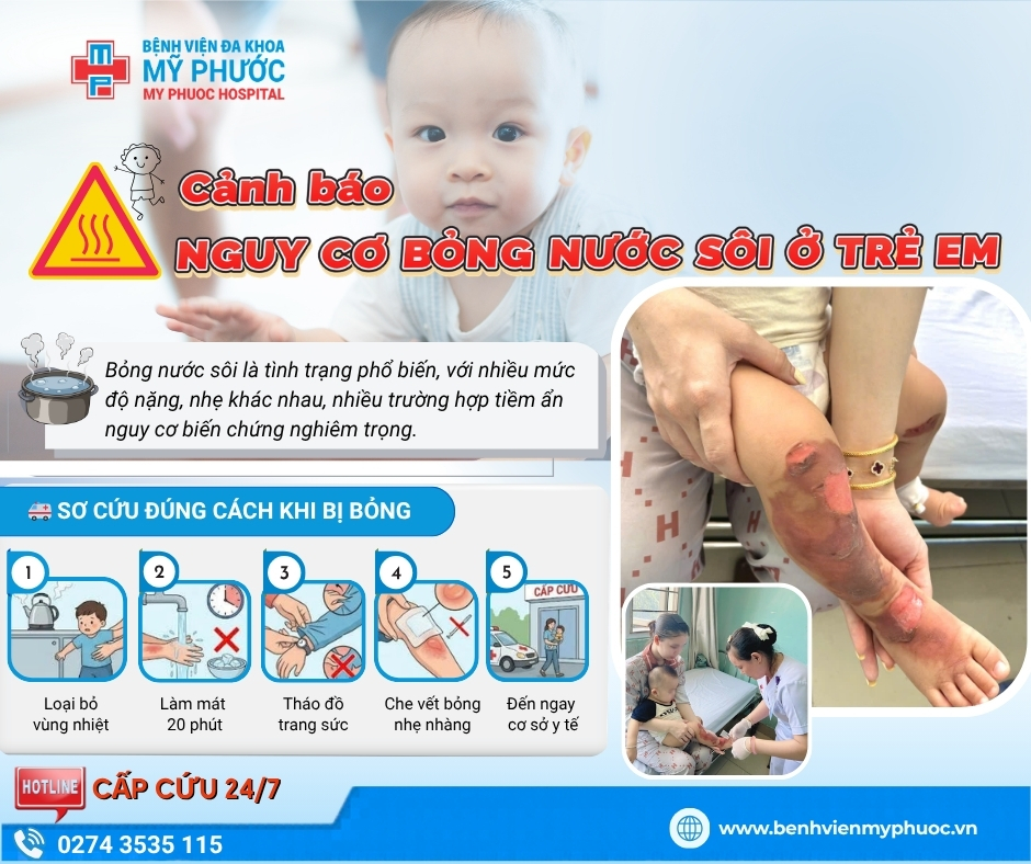 CẢNH BÁO: Hiểm họa bỏng nước sôi ở trẻ nhỏ