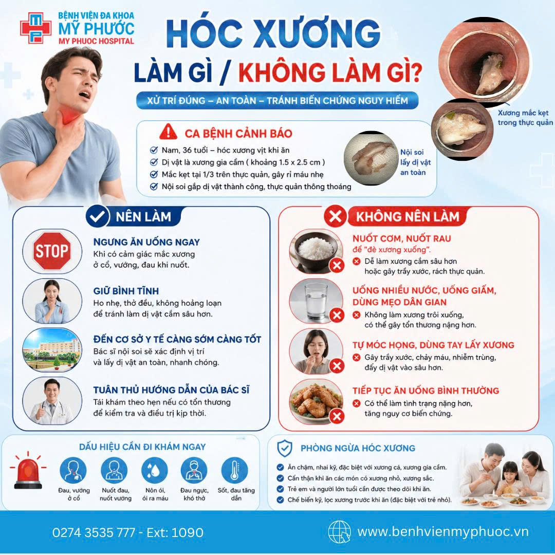 Hóc xương vịt – nguy cơ không ngờ từ bữa ăn 