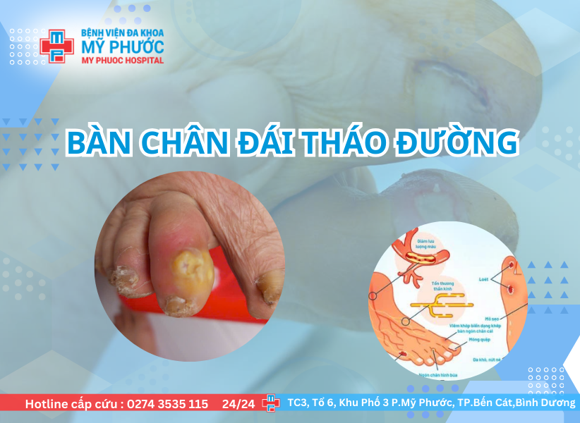 Biến chứng bàn chân đái tháo đường – đừng để vết xước nhỏ trở thành biến chứng lớn